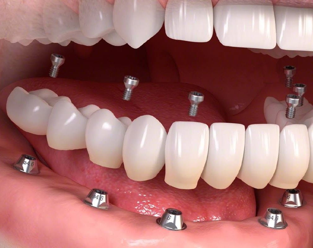 Implantatprotetikk